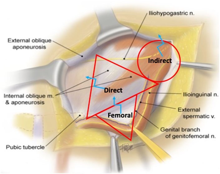 direct and indirect inguinal hernia