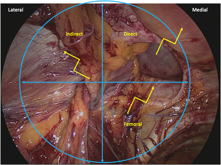 Open femoral hernia repair: one skin incision for all, World Journal of  Emergency Surgery